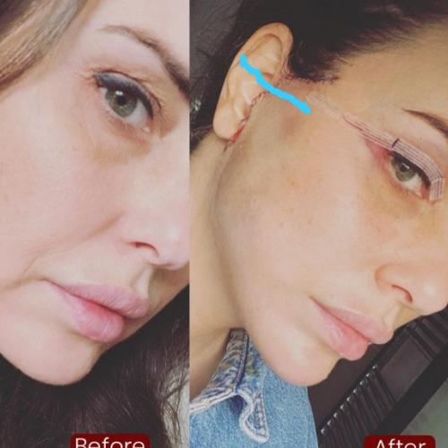 Mini facelift Before / After photo